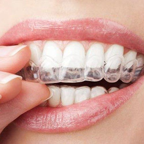 Understanding The Different Types Of Dental Braces: Which Is Right For You?
